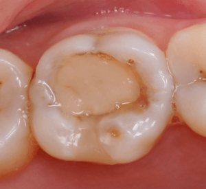 Лечение и реставрация жевательного зуба композитной пломбой