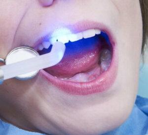 Пломбирование зуба материалом светового отверждения