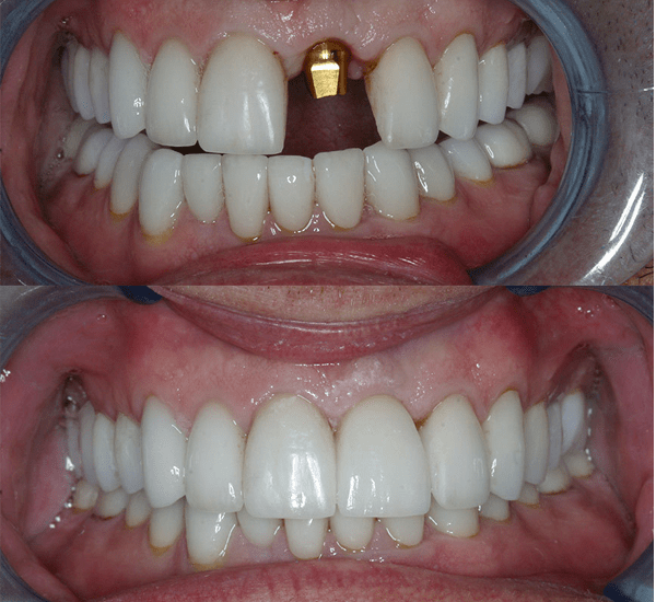 Наращивание зуба материалом светового отверждения